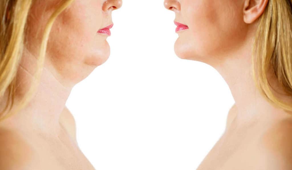 Double Chin treatment Cardiff before and after results