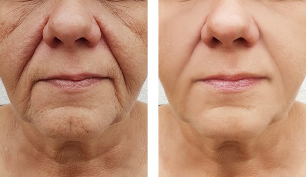 Learn more about Morpheus8 Treatment Cardiff today!
