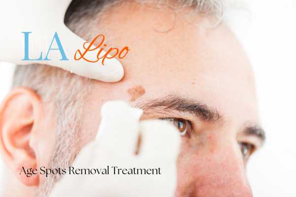 What Are the Most Effective Treatments for Age Spots Cardiff?
