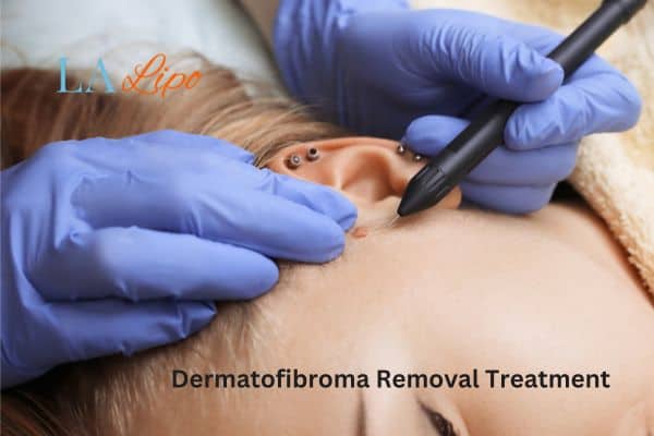 Dermatofibroma Removal Treatment Cardiff