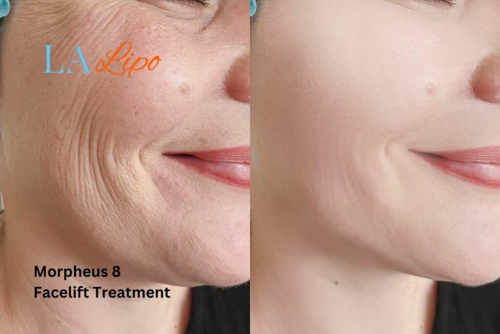 Morpheus8 Treatment Cardiff for flawless skin! Call us today!