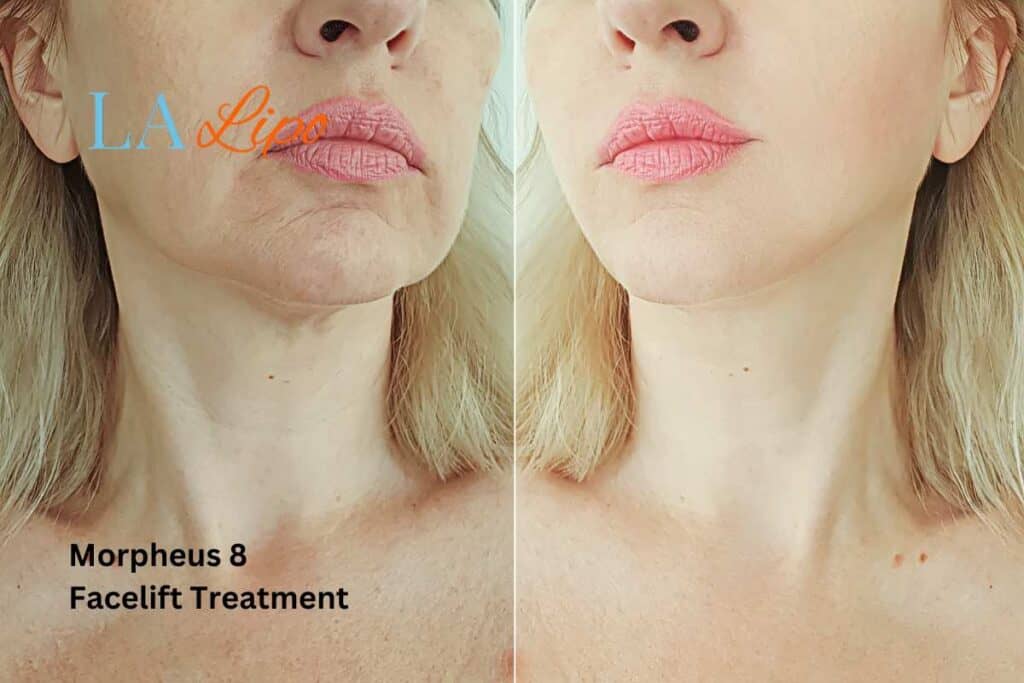 Turn back time with Morpheus8 Treatment Cardiff