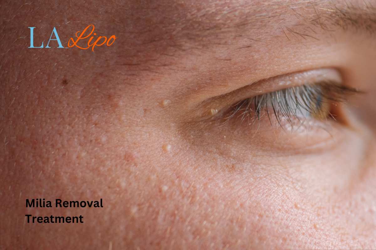 Cryopen Milia Removal: Is It the Easiest and Safest Option Cardiff?