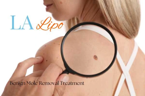 Why getting moles removed Cardiff can boost your confidence!