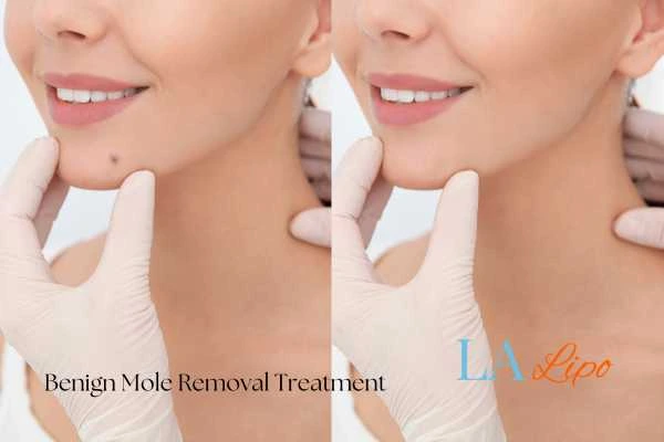 woman's before and after mole removal Cardiff results