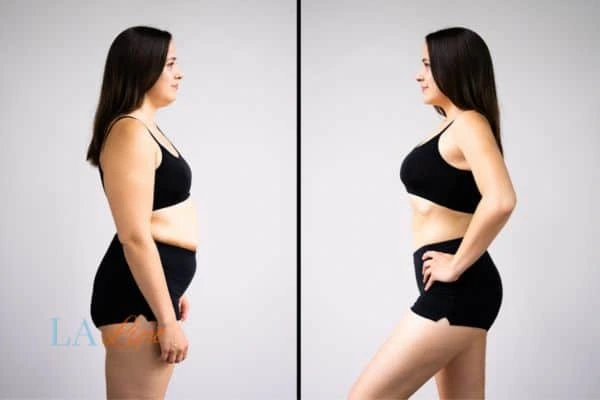image of woman before and after results of LA-EMS Body Sculpting Cardiff to help treat Diastasis recti