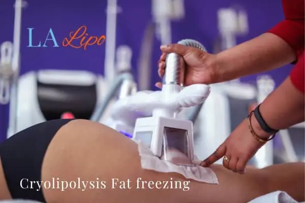 women getting fat freezing Cardiff