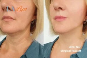 hi-fu for wrinkles Cardiff before and after results