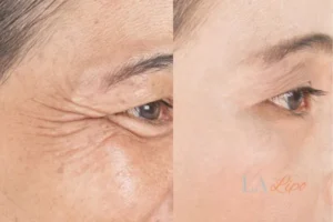 Before and after results of woman - HI-fu wrinkles reduction treatment Cardiff