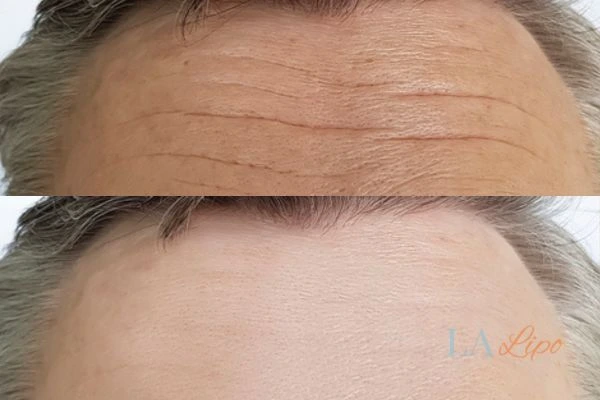 results of HIFU Cardiff on mans forehead to help reduce lines and wrinkles