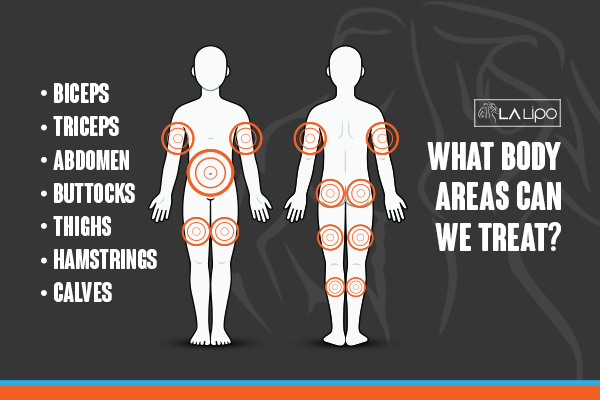 Graphic to show areas you can have LA-EMS Body Sculpting Cardiff treatment.