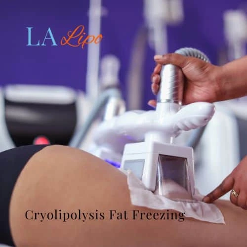 fat freezing - Cryolipolysis Cardiff