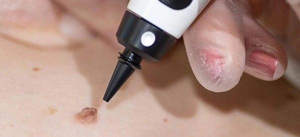 skin tag removal using cryopen Cardiff