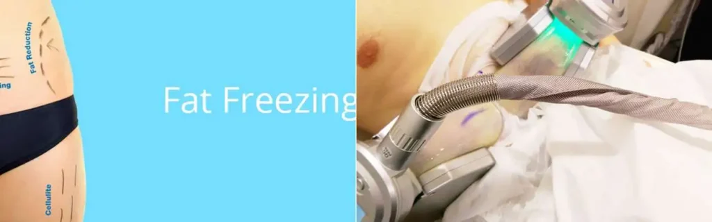 Fat freezing Cardiff on multiple areas of the body