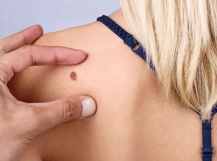 woman having mole removal Cardiff consultation before treatment.