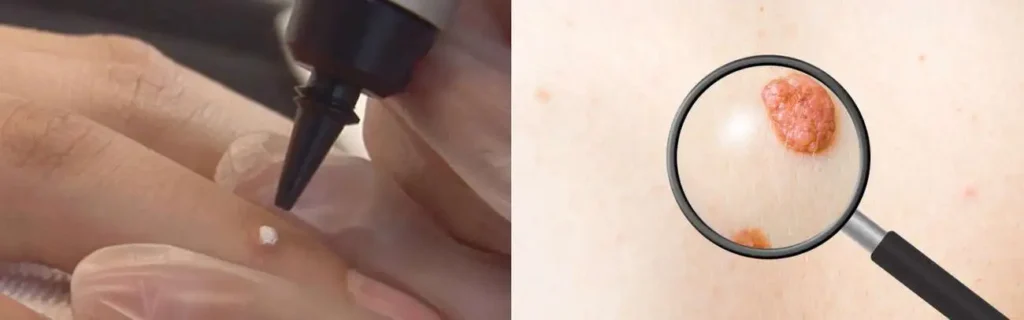Cryopen for mole removal Cardiff - speak to our team today!