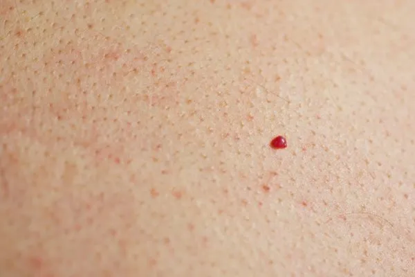 close up of a cherry angioma Cardiff