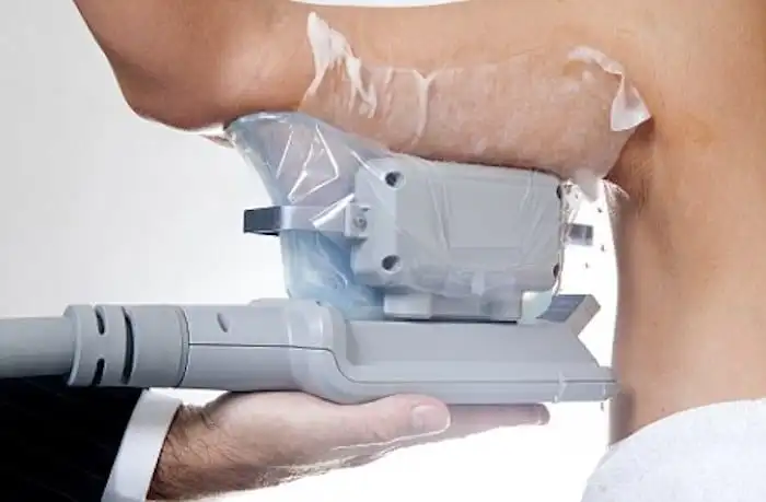 Picture of fat freezing Cardiff on the upper arms.