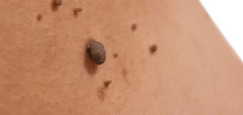 image of a skin tag Cardiff