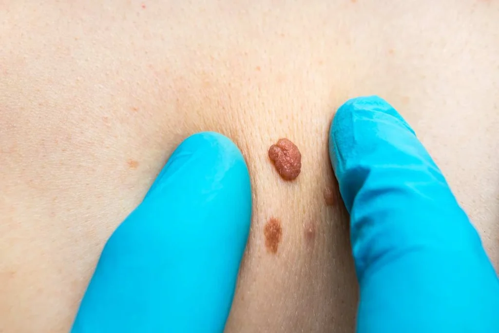 Consultant examining a skin tag Cardiff