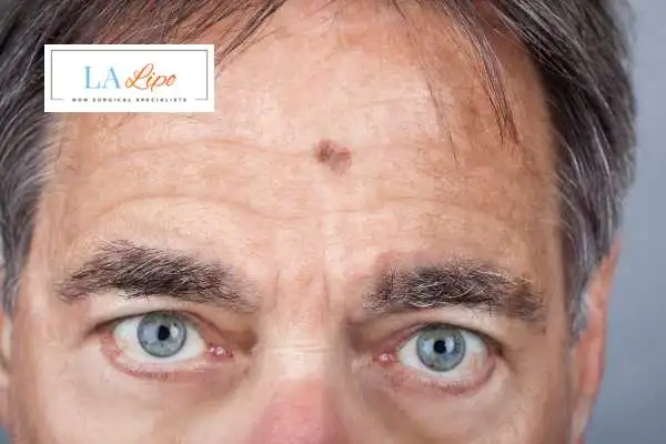 Solar Lentigo Removal Cardiff image of man with mark on his forehead