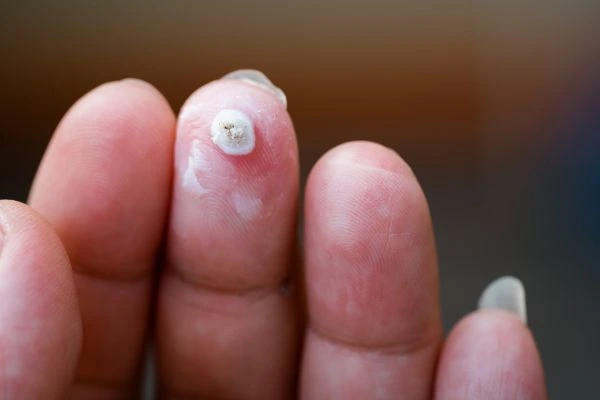 wart on person finger - cryotherapy to treat from LA LIPO Cardiff