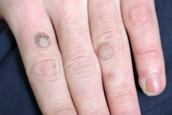 photo of warts on person hand - see wart removal Cardiff from LA LIPO
