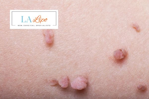 Does cryopen skin tag removal Cardiff hurt? Find out now call our team today!