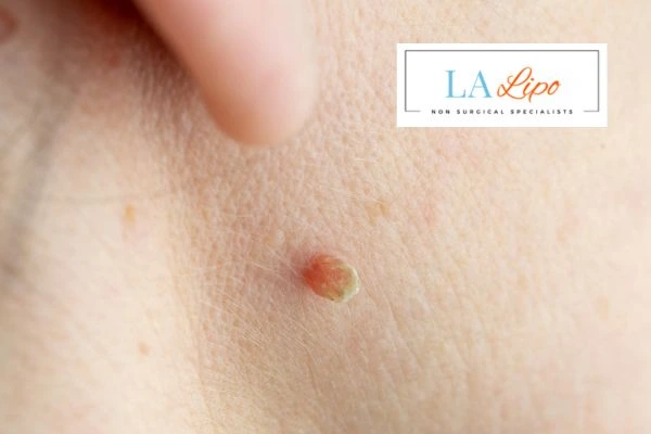 Book skin tag removal Cardiff today speak to our team now!