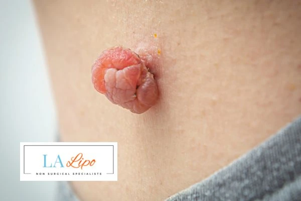 Interested in skin tag removal Cardiff? Concerned about the pain? Find out more today!
