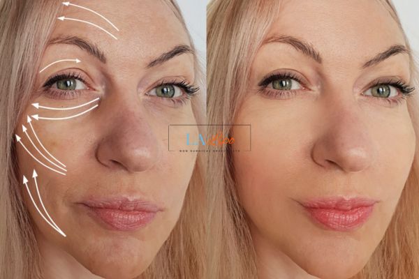 Morpheus 8 results Cardiff face lift.