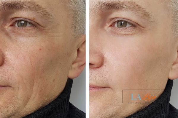 See the amazing results of Morpheus8 Treatment Cardiff!