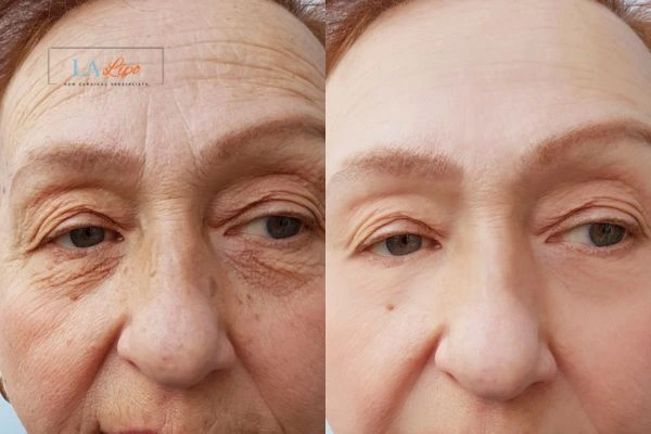 The powerful benefits of Morpheus8 Treatment Cardiff - Call Our team today!