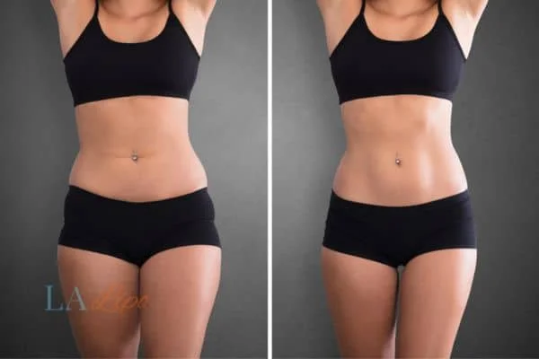 before and after results of non-surgical treatment to help a woman's body image and mental health Cardiff