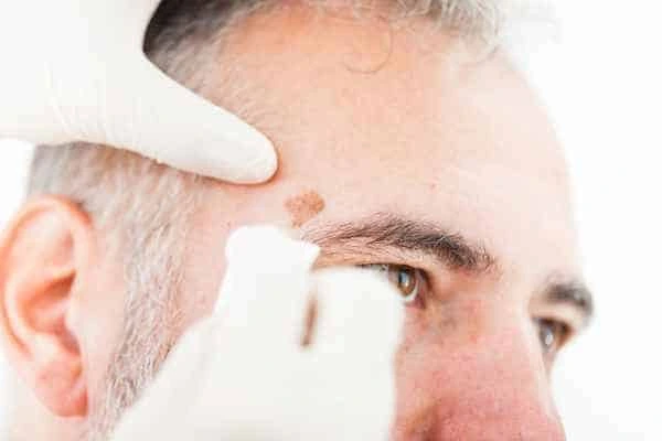 Age spots and elderly people Cardiff what is the link?