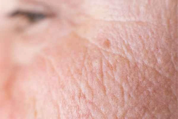 close up picture of a woman's face showing an age spot Cardiff