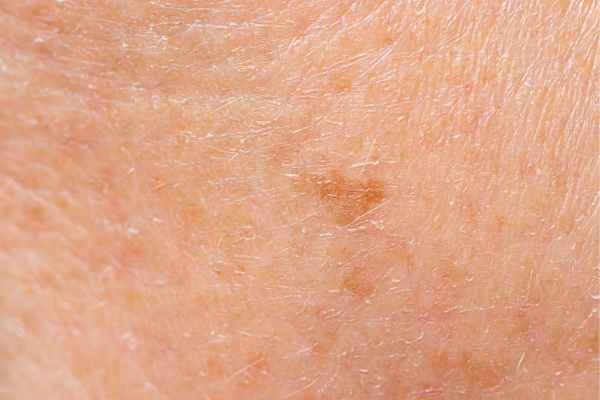 close up picture of age spots Cardiff