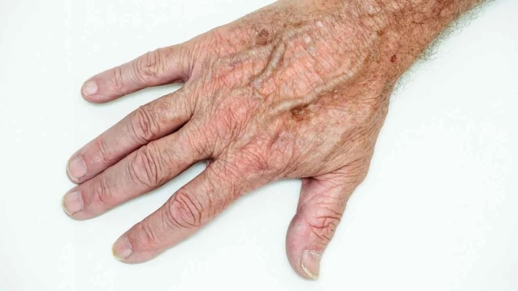 Male hand showing age spot Cardiff