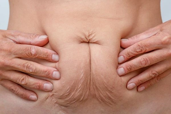 Image of a woman's stomach with loose skin - example of skin tightening Cardiff options