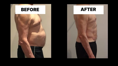 What Symptoms Can Diastasis Recti Cause in Men? Weak Core, Back Pain and Poor Posture Cardiff